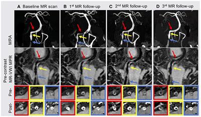 Case Report: Serial MR Vessel Wall Imaging Visualizes the Response of Intracranial Plaques and Assists in Decision-Making